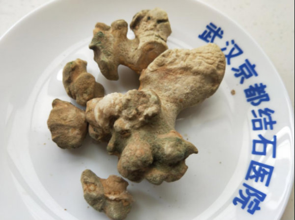 7月武漢京都結石醫(yī)院大事記